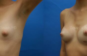 Breast Augmentation Before and After | Sayah Institute