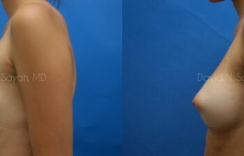 Breast Augmentation Before and After | Sayah Institute