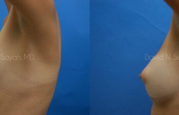 Breast Augmentation Before and After | Sayah Institute