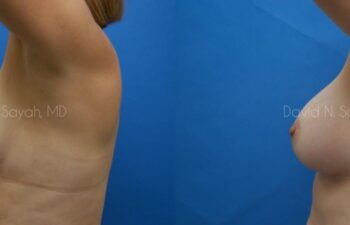 Breast Augmentation Before and After | Sayah Institute