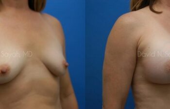 Breast Augmentation Before and After | Sayah Institute