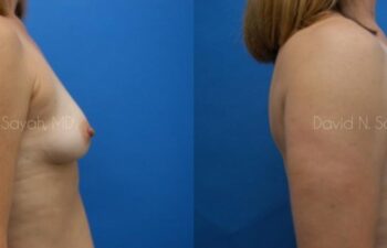 Breast Augmentation Before and After | Sayah Institute