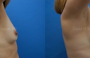 Breast Augmentation Before and After | Sayah Institute