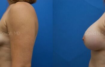 Breast Augmentation Before and After | Sayah Institute