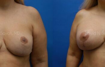 Breast Augmentation And Mastopexy Before and After | Sayah Institute