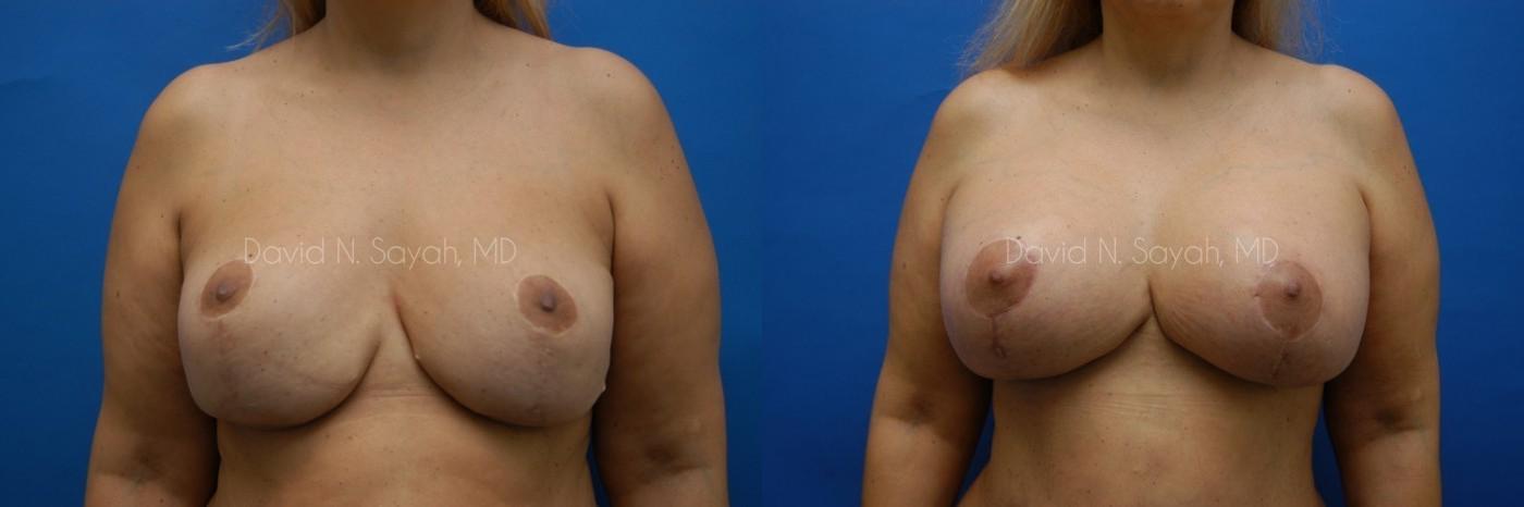 Breast Augmentation And Mastopexy Before and After | Sayah Institute