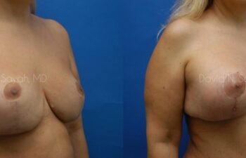 Breast Augmentation And Mastopexy Before and After | Sayah Institute