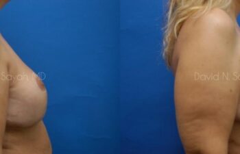 Breast Augmentation And Mastopexy Before and After | Sayah Institute