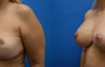 Breast Augmentation And Mastopexy Before and After | Sayah Institute