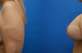 Breast Augmentation And Mastopexy Before and After | Sayah Institute