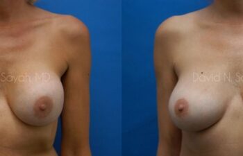 Breast Implant Exchange Before and After | Sayah Institute