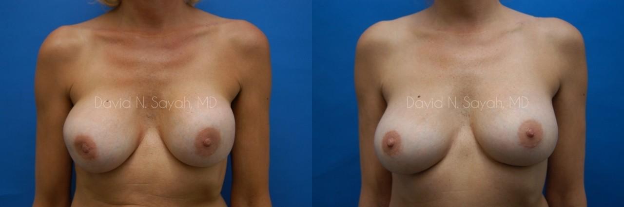 Breast Implant Exchange Before and After | Sayah Institute