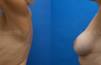 Breast Implant Exchange Before and After | Sayah Institute