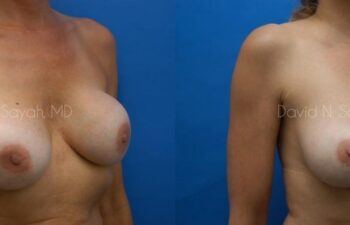 Breast Implant Exchange Before and After | Sayah Institute