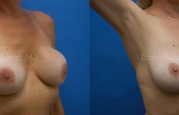 Breast Implant Exchange Before and After | Sayah Institute