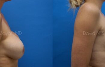 Breast Implant Exchange Before and After | Sayah Institute