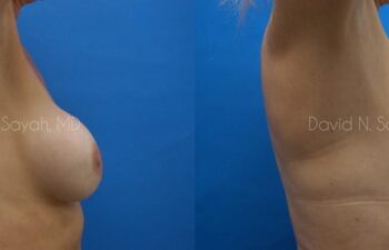 Breast Implant Exchange Before and After | Sayah Institute