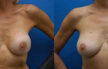 Breast Implant Exchange Before and After | Sayah Institute