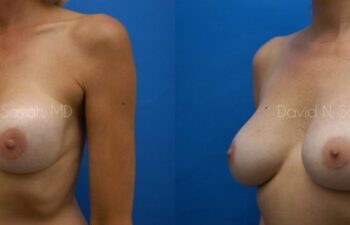 Breast Implant Exchange Before and After | Sayah Institute