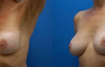 Breast Implant Exchange Before and After | Sayah Institute