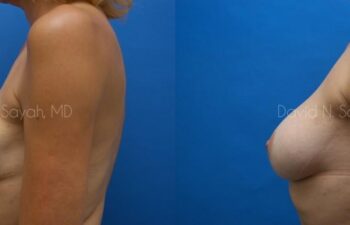 Breast Implant Exchange Before and After | Sayah Institute