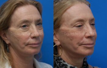 Fat Injection Face Before and After | Sayah Institute