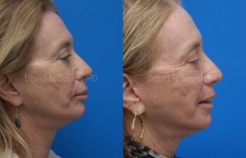 Fat Injection Face Before and After | Sayah Institute