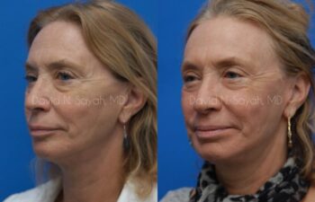 Fat Injection Face Before and After | Sayah Institute