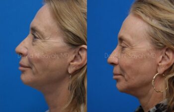 Fat Injection Face Before and After | Sayah Institute