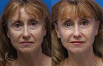 Fat Injection Face Before and After | Sayah Institute