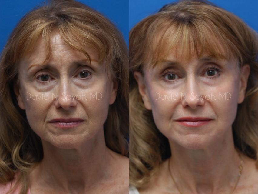 Fat Injection Face Before and After | Sayah Institute