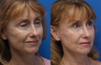 Fat Injection Face Before and After | Sayah Institute