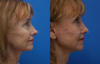 Fat Injection Face Before and After | Sayah Institute
