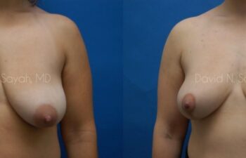 Breast Lift Before and After | Sayah Institute