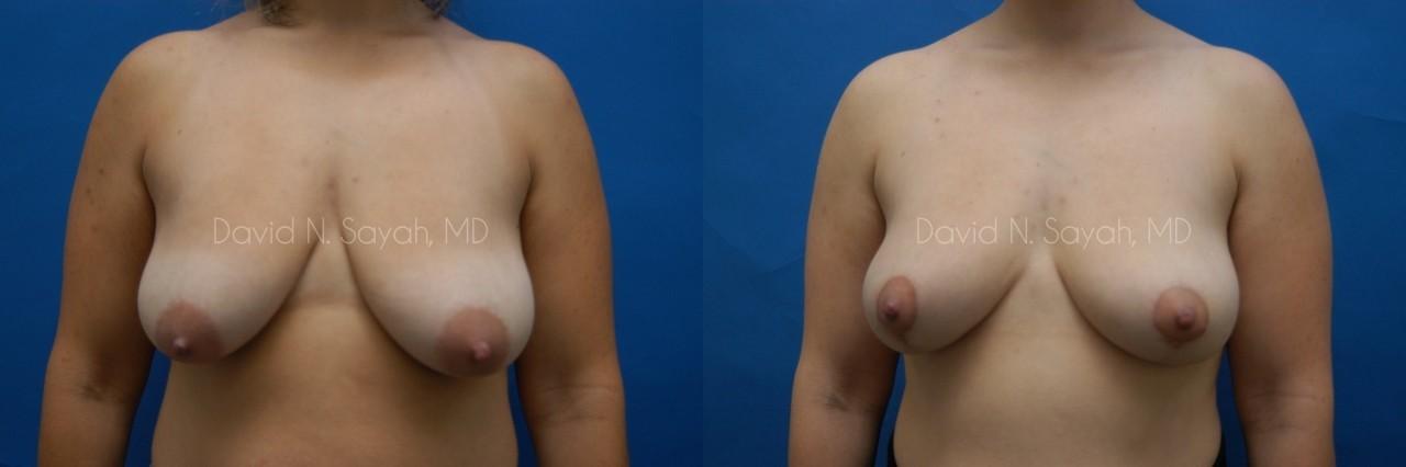 Breast Lift Before and After | Sayah Institute