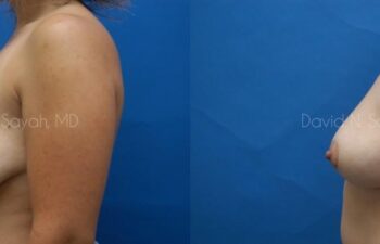 Breast Lift Before and After | Sayah Institute