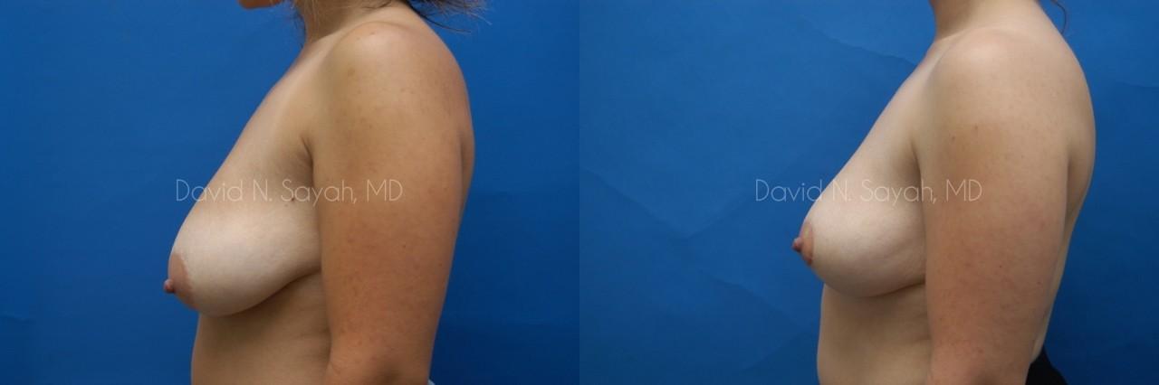 Breast Lift Before and After | Sayah Institute