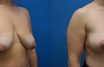 Breast Lift Before and After | Sayah Institute