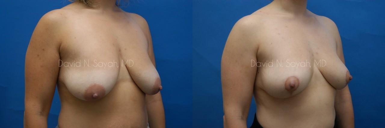 Breast Lift Before and After | Sayah Institute