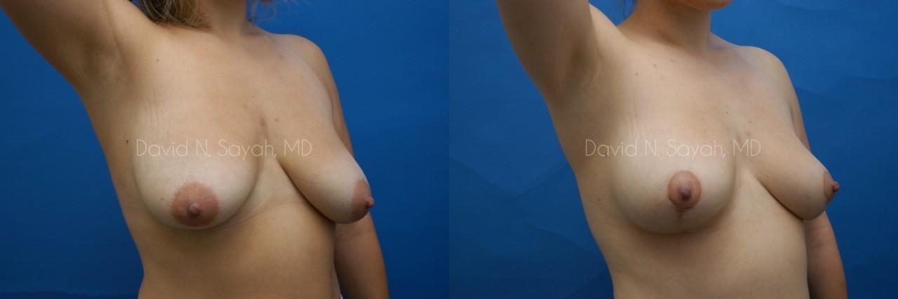 Breast Lift Before and After | Sayah Institute