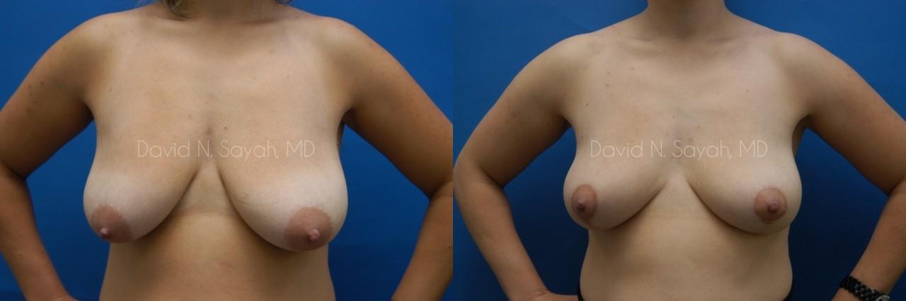 Breast Lift Before and After | Sayah Institute