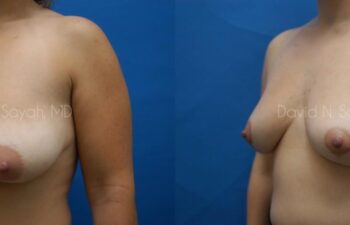 Breast Lift Before and After | Sayah Institute
