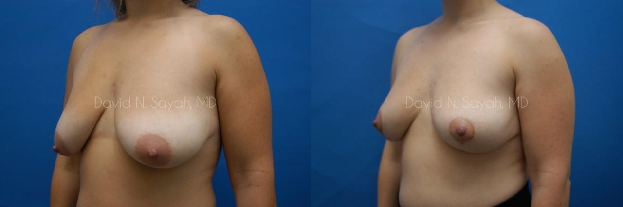 Breast Lift Before and After | Sayah Institute