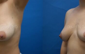 Breast Lift Before and After | Sayah Institute