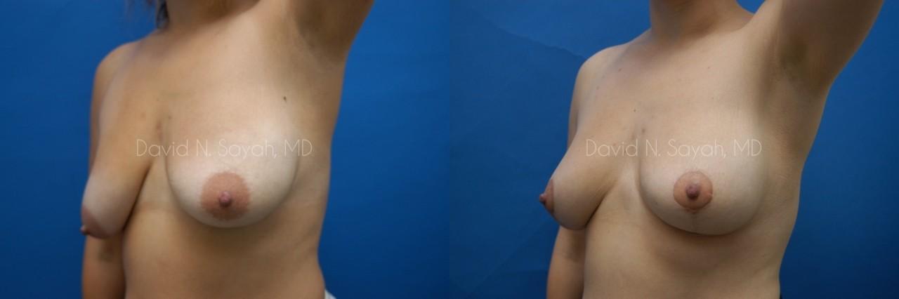 Breast Lift Before and After | Sayah Institute