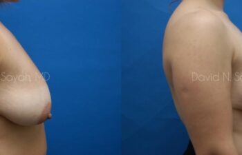 Breast Lift Before and After | Sayah Institute