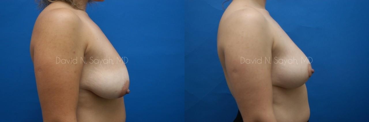 Breast Lift Before and After | Sayah Institute