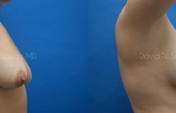 Breast Lift Before and After | Sayah Institute
