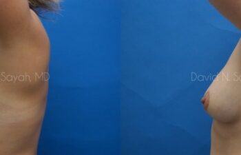 Breast Lift Before and After | Sayah Institute