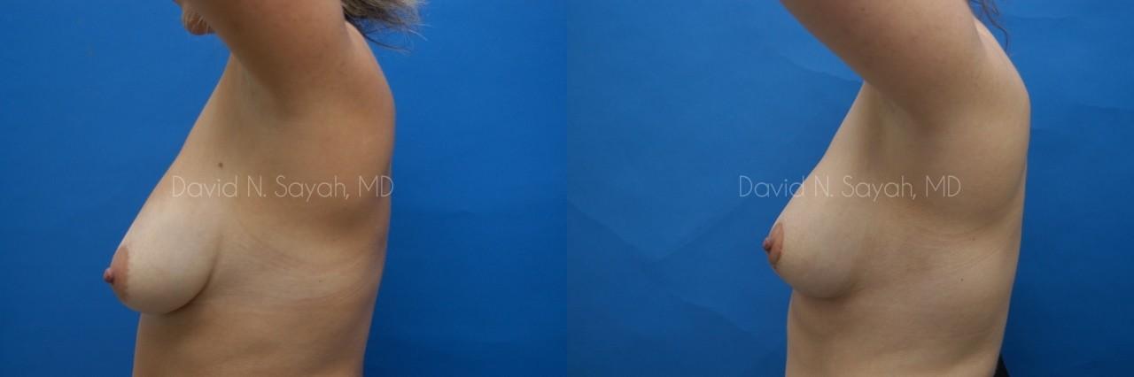 Breast Lift Before and After | Sayah Institute